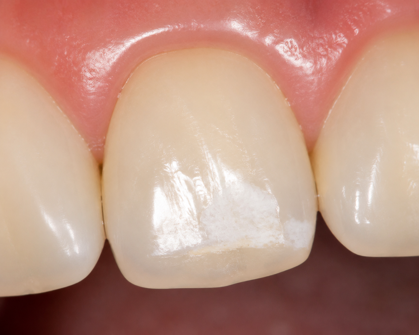How to Get Rid of White Scars on Teeth