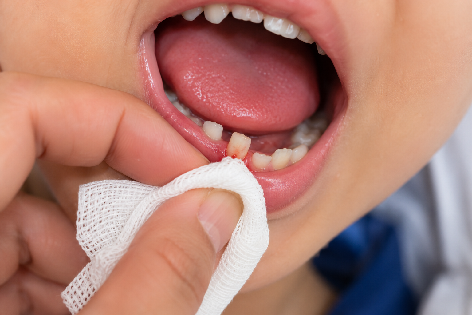 How to Pull a Loose Tooth
